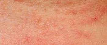 Adolescent difficile