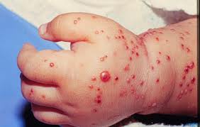 Lesion