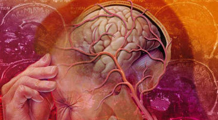 Migraine depression