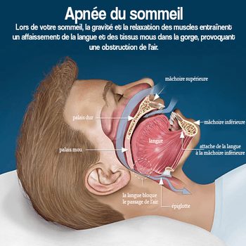 Apnée